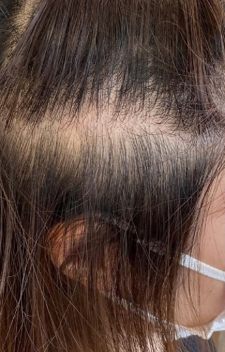 40代女性 分け目・つむじの薄毛 Before